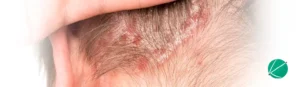 Dermatite Seborreica - Clinica Dermatologista em São Carlos