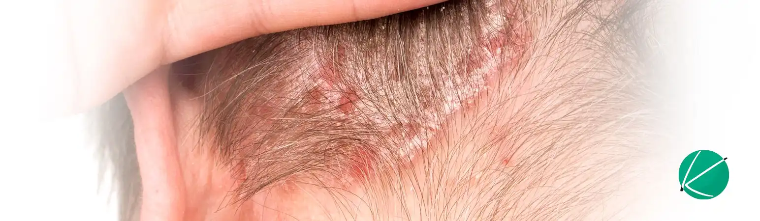Dr. Maçatochi comenta sobre tratamentos para dermatite seborreica