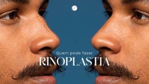 rinoplastia em São Carlos