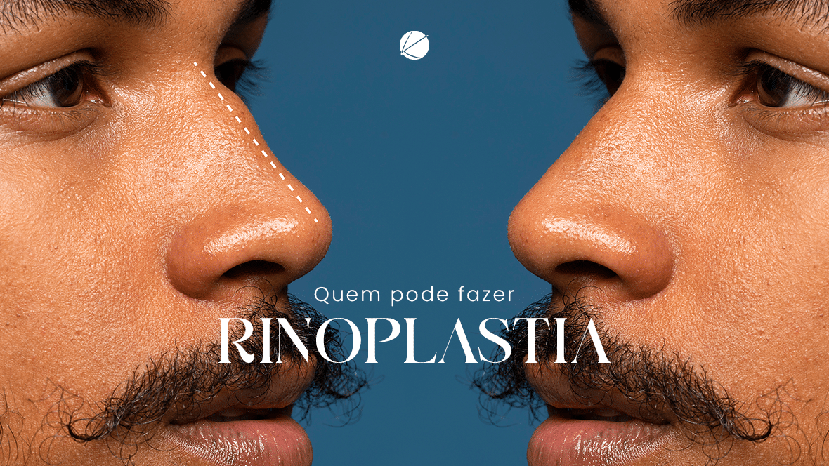 rinoplastia em São Carlos