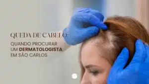 Queda de cabelo - quando procurar um dermatologista em São Carlos