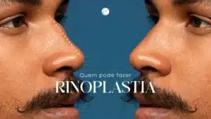 Rinoplastia em São Carlos