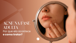 Acne na fase adulta