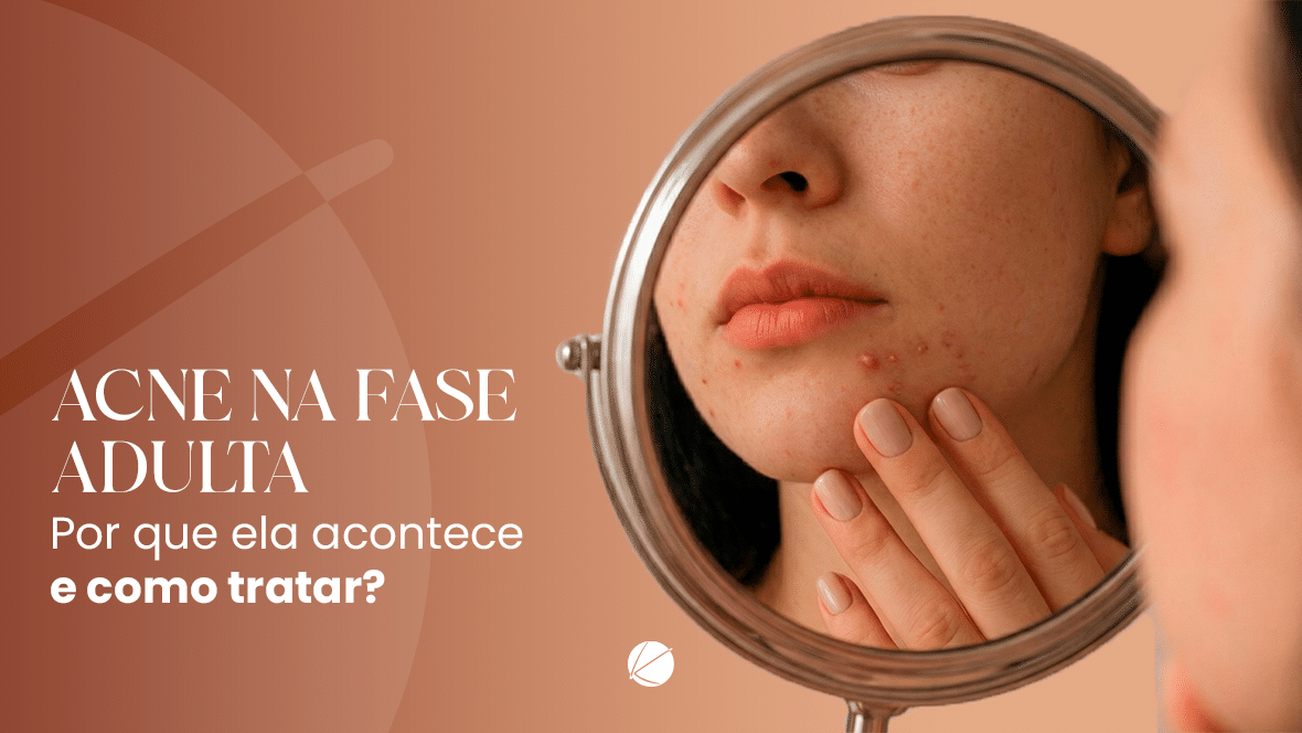 Acne na fase adulta