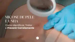 Dermatologista em São Carlos explica como identificar e tratar micose de pele e unha